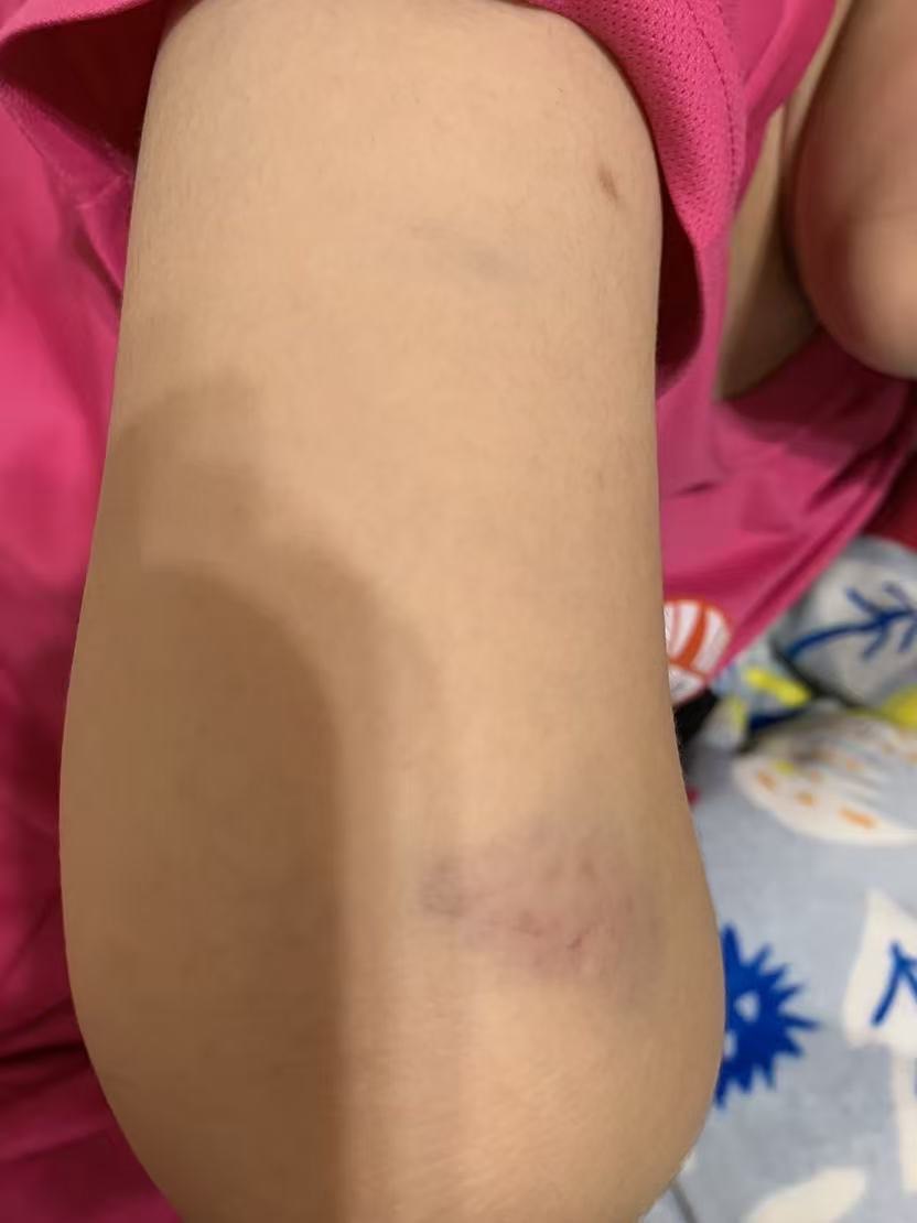 【獨家】【新北校園霸凌爭議】三峽安溪國中女學生遭同學毆傷瘀青!! 家長怒控劣師失職還附和共笑 遭霸凌女學生身體多處部位遭毆瘀青。(圖:投訴者提供)