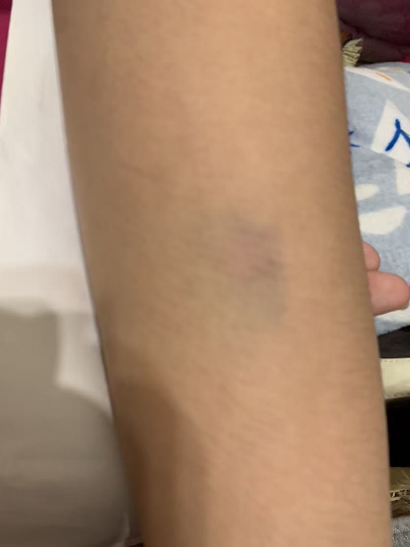 【獨家】【新北校園霸凌爭議】三峽安溪國中女學生遭同學毆傷瘀青!! 家長怒控劣師失職還附和共笑 遭霸凌女學生身體多處部位遭毆瘀青。(圖:投訴者提供)